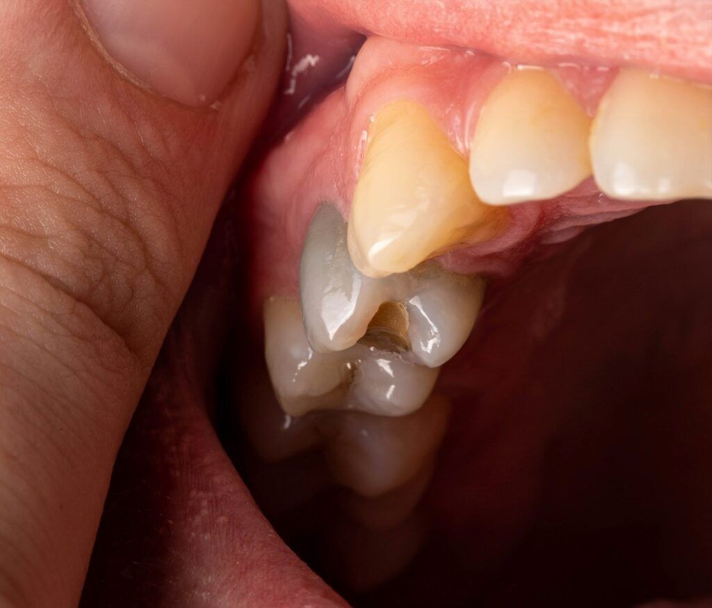 Picture of: Black Teeth: Symptoms, Causes and Treatment – The Dental Centre