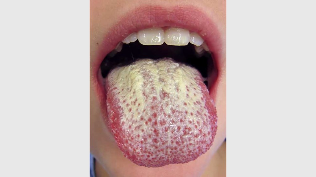 Picture of: Green Tongue: Causes, Syndromes, and Treatment