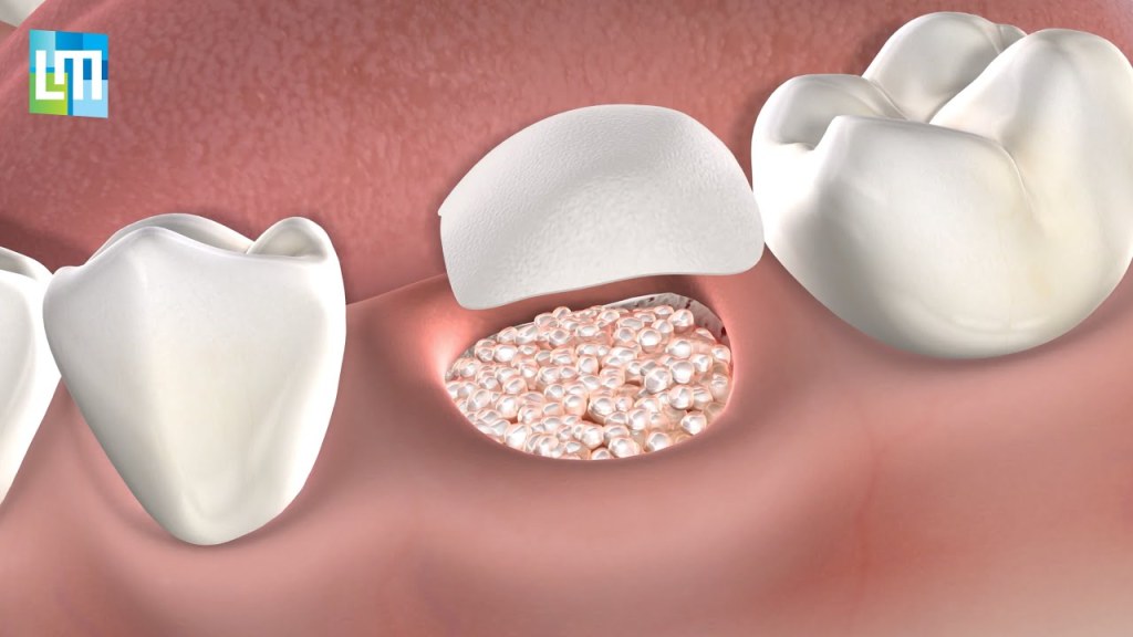 Picture of: Post-Operative Instructions: Bone Graft  Lehman & Menis Dental Implant and  Oral Surgery Specialists
