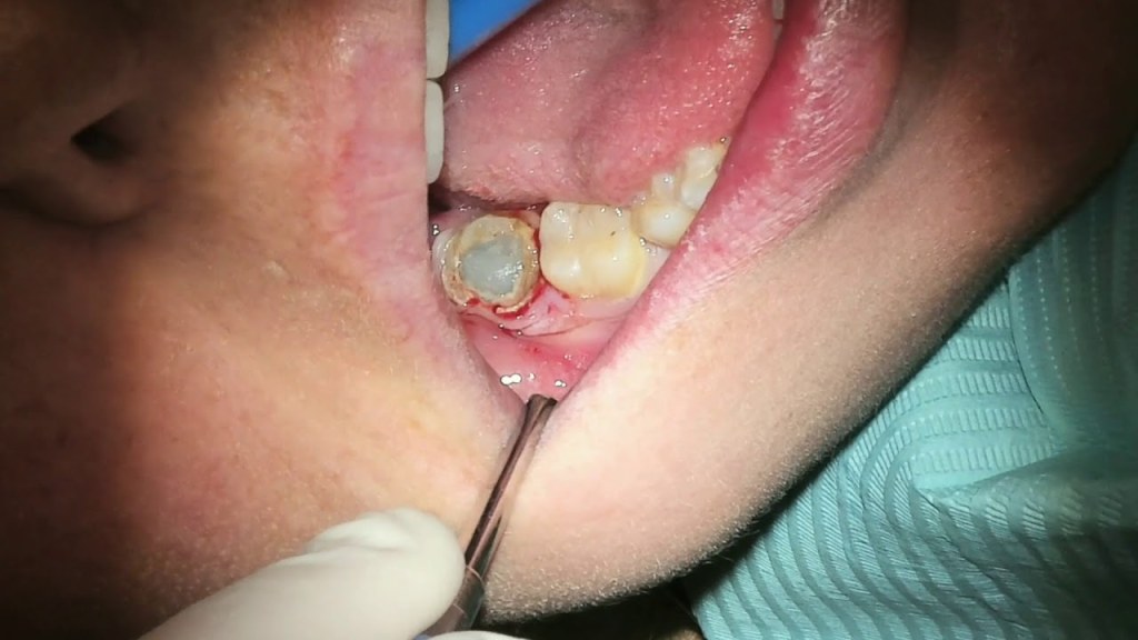Picture of: Pus from Infected Wisdom Tooth