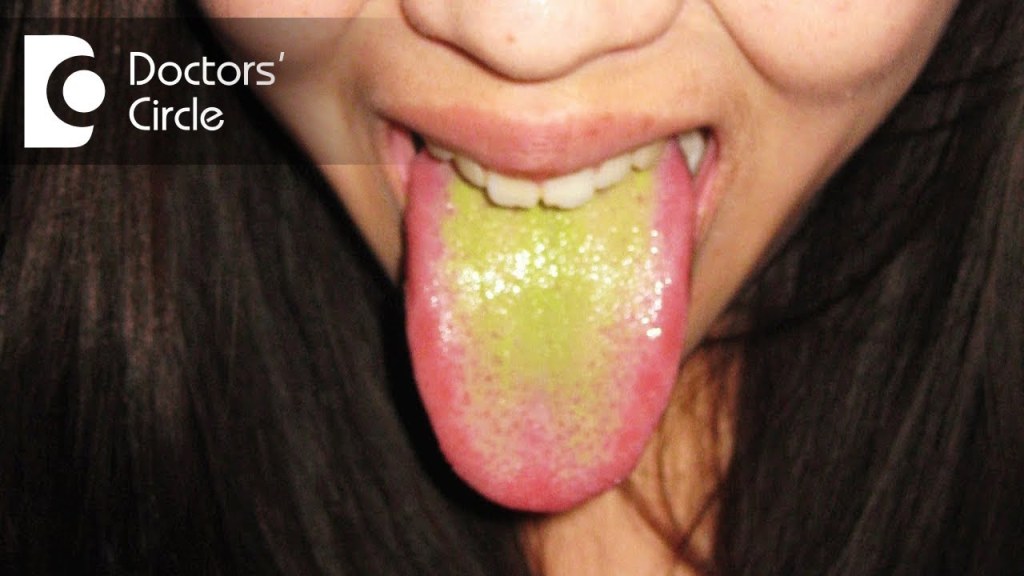 Picture of: What causes green discoloration of tongue? – Dr